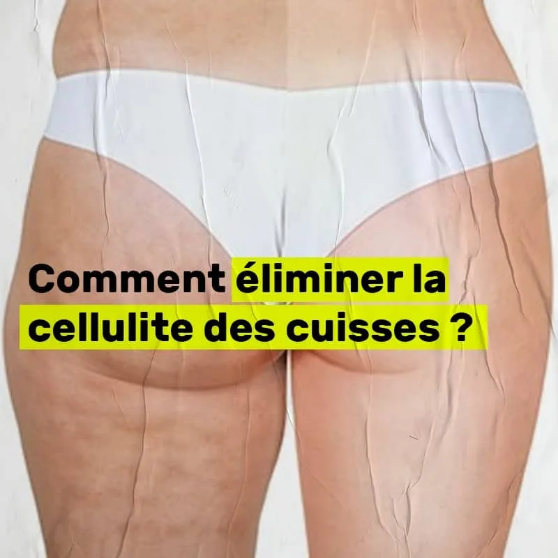 Cellulite des fessiers et cuisses